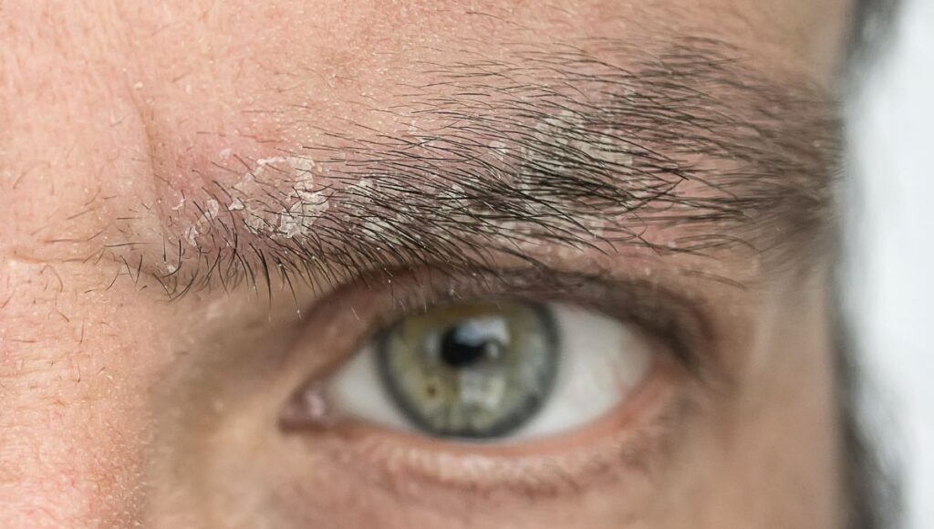 Las razones por las que sale caspa en las cejas y los ojos
