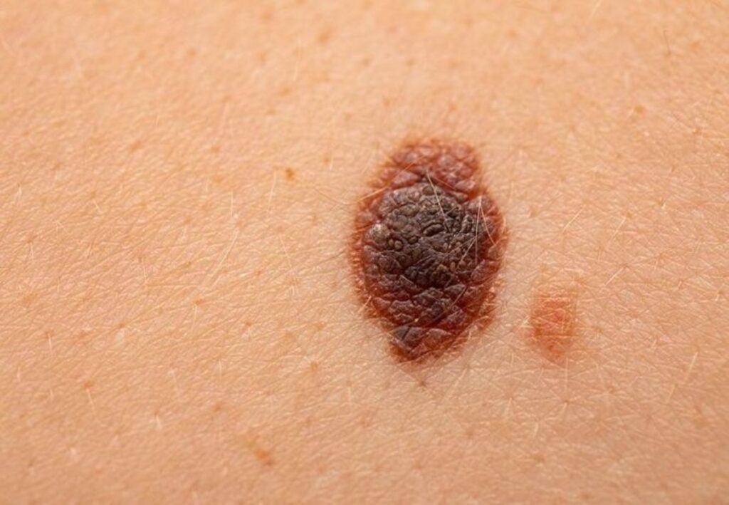 Qué tan curable es el cáncer de piel