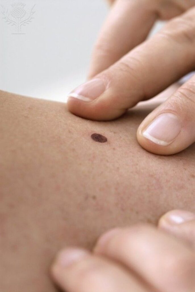 Cómo comienza el cáncer de piel