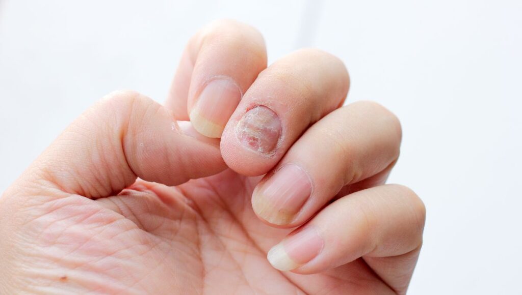La psoriasis es más común en codos rodillas y uñas.