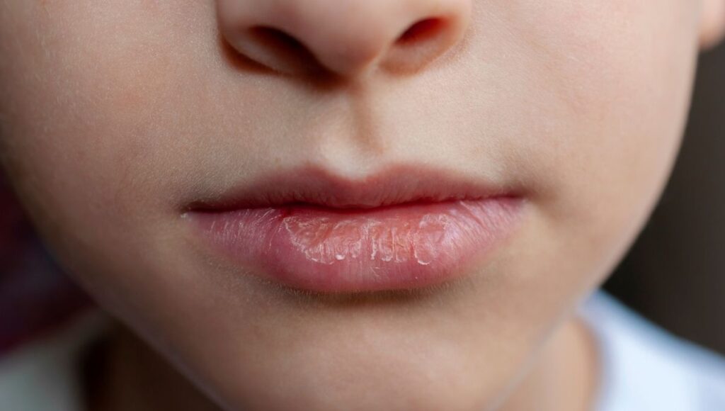 Labios secos y tratamiento