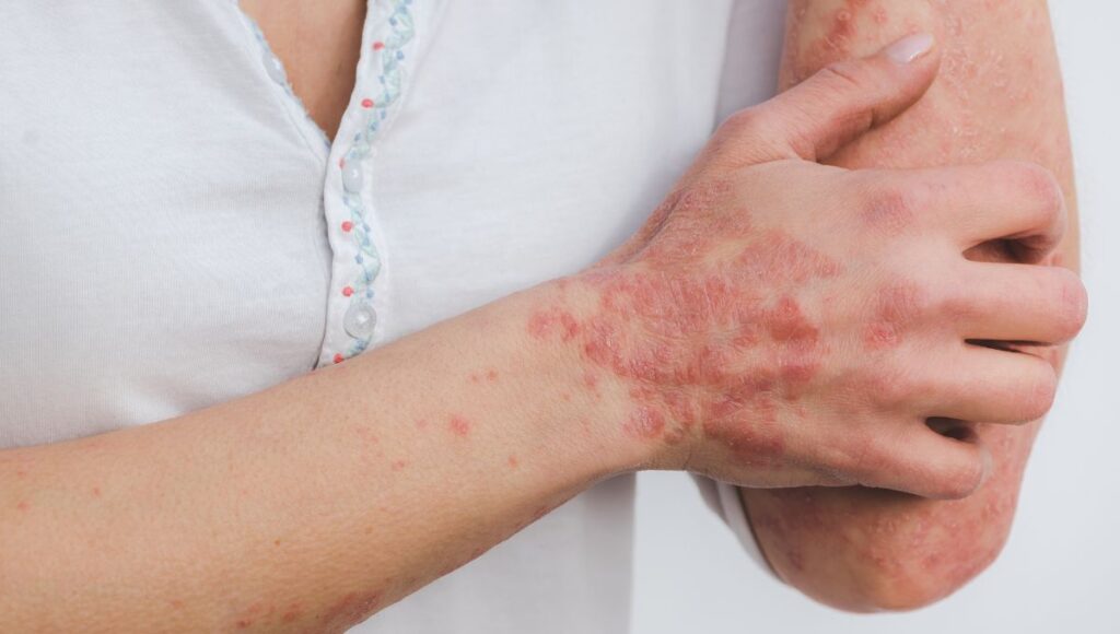 psoriasis signos síntomas tiene cura