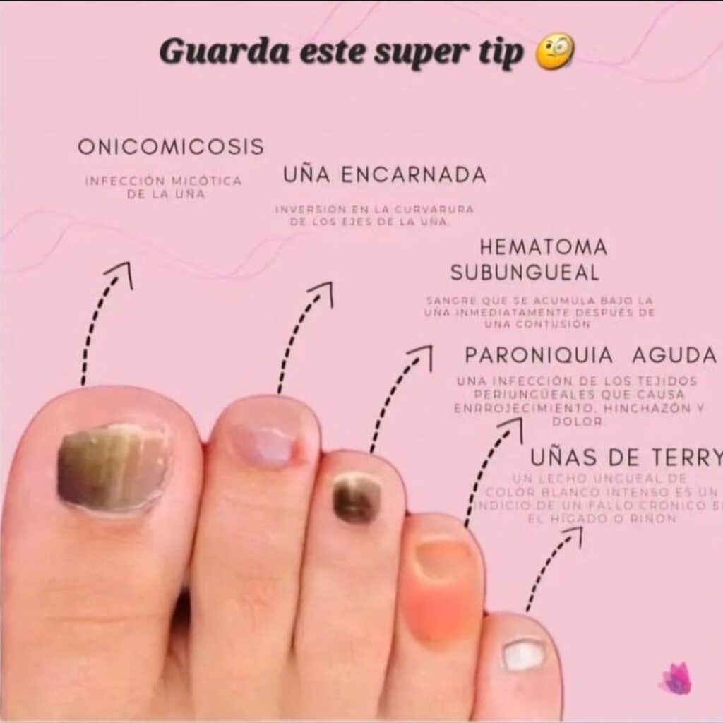 Cómo se llama la enfermedad de las uñas de los pies