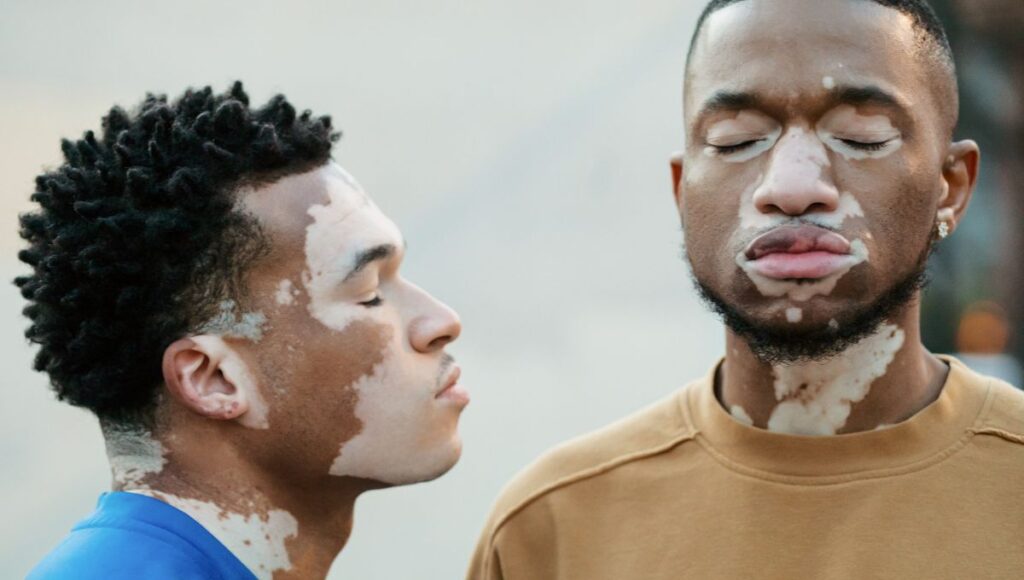 frases dia mundial del vitiligo