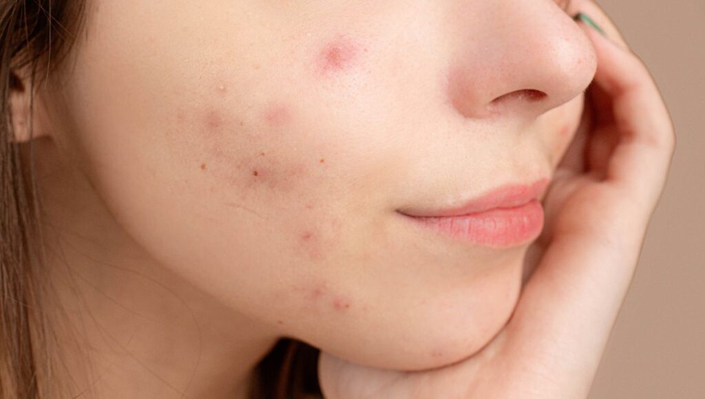 como borrar las manchas de acne