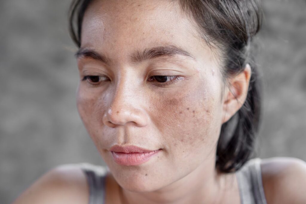 efectos secundarios del retinol