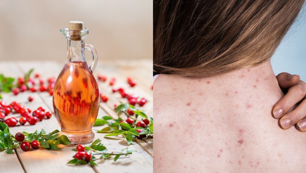 como borrar las manchas de acne en espalda y brazos